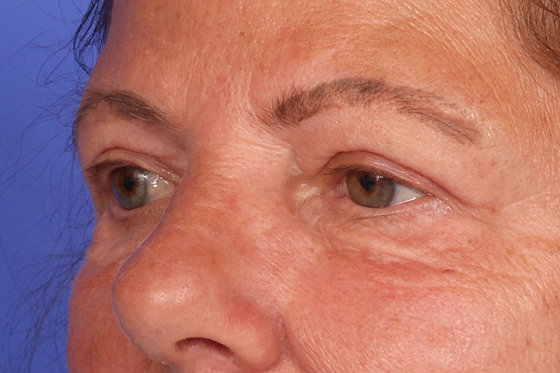 Eyelid Surgery Before & After Image