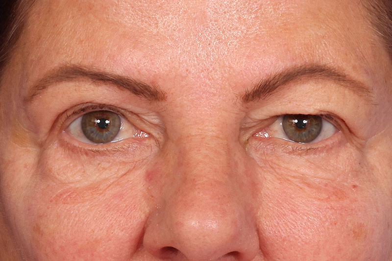Eyelid Surgery Before & After Image