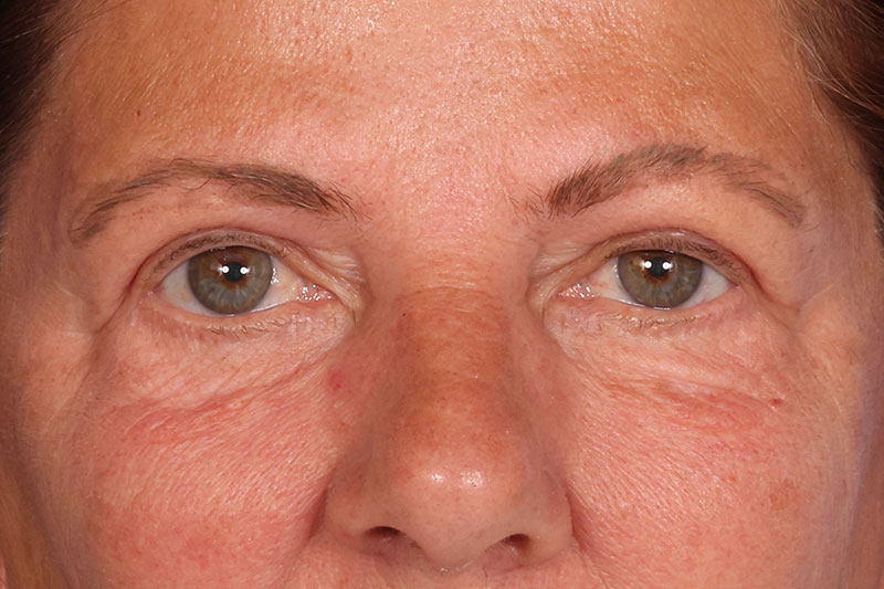 Eyelid Surgery Before & After Image