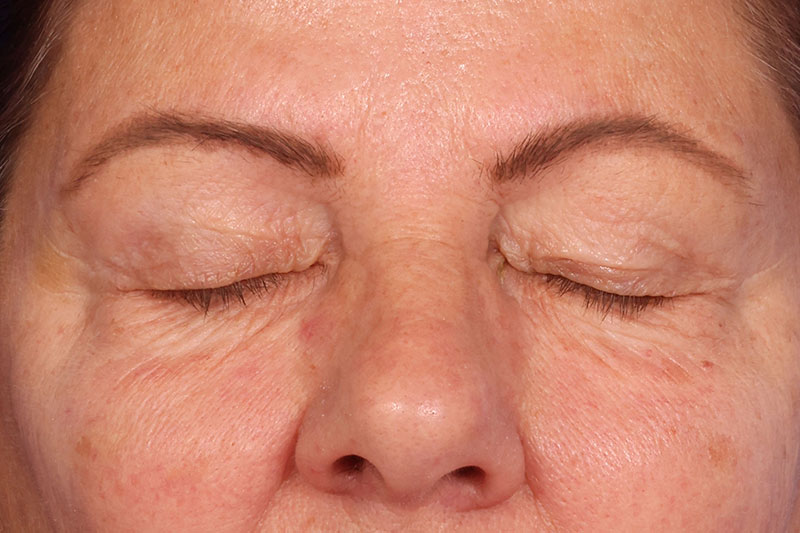Eyelid Surgery Before & After Image
