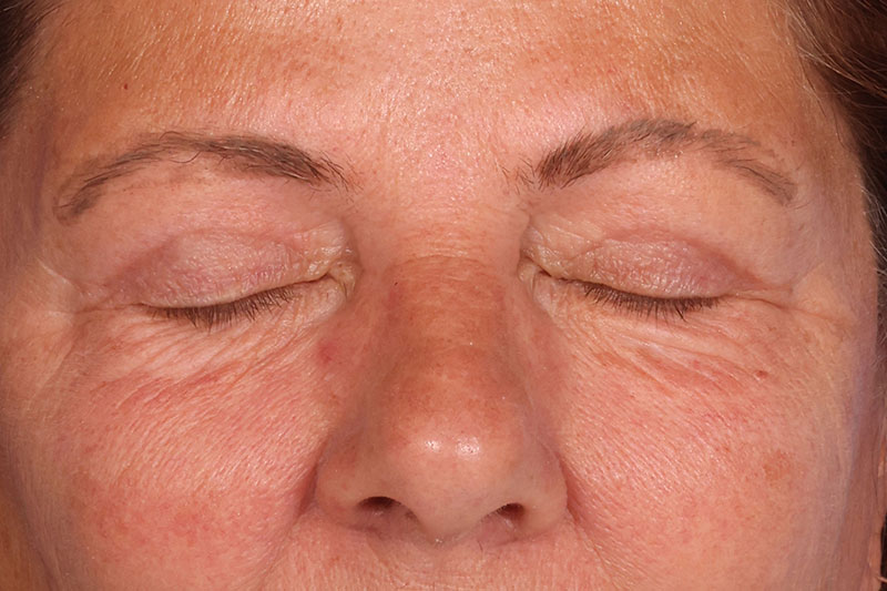 Eyelid Surgery Before & After Image