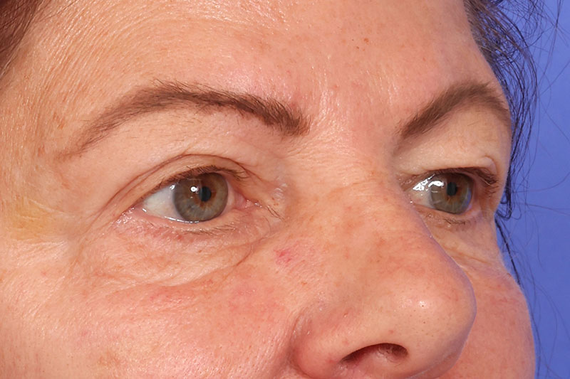 Eyelid Surgery Before & After Image
