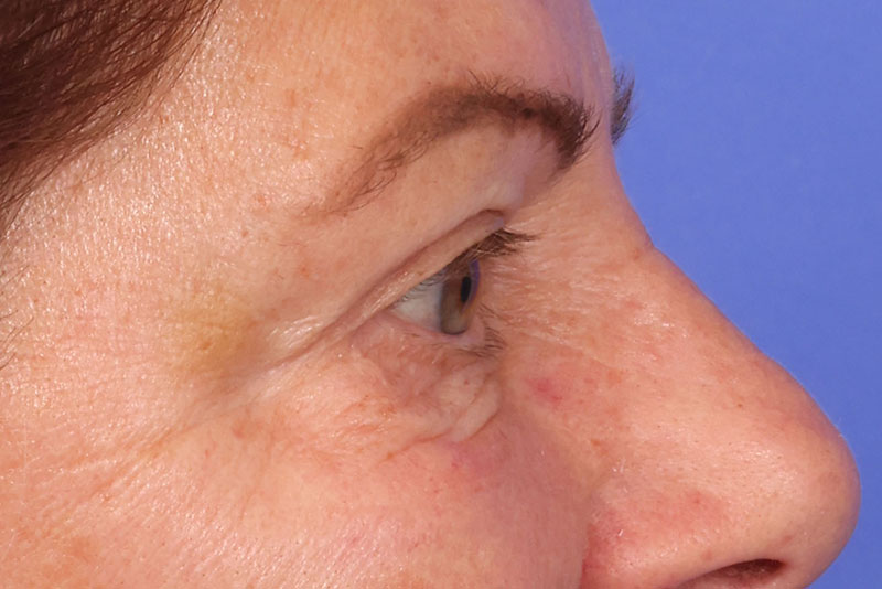Eyelid Surgery Before & After Image