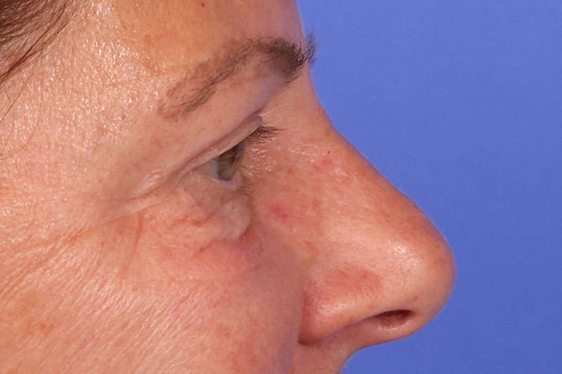 Eyelid Surgery Before & After Image