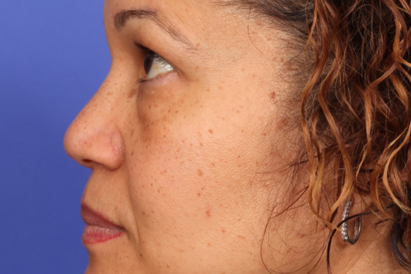 Eyelid Surgery Before & After Image