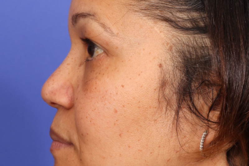 Eyelid Surgery Before & After Image