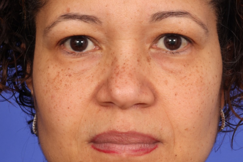 Eyelid Surgery Before & After Image