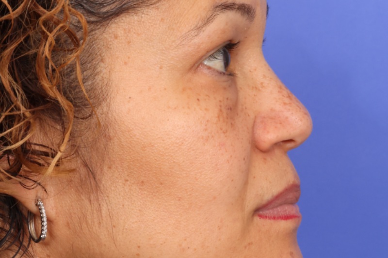 Eyelid Surgery Before & After Image
