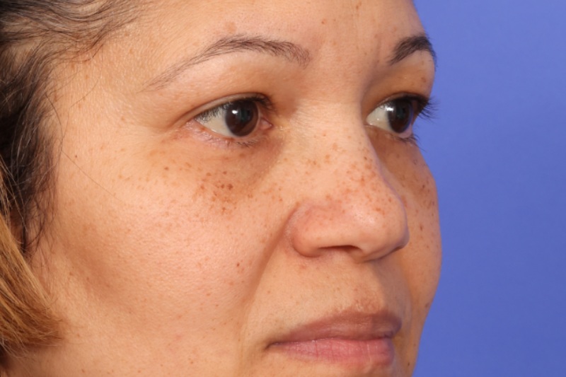 Eyelid Surgery Before & After Image