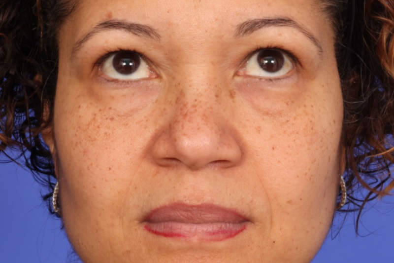 Eyelid Surgery Before & After Image