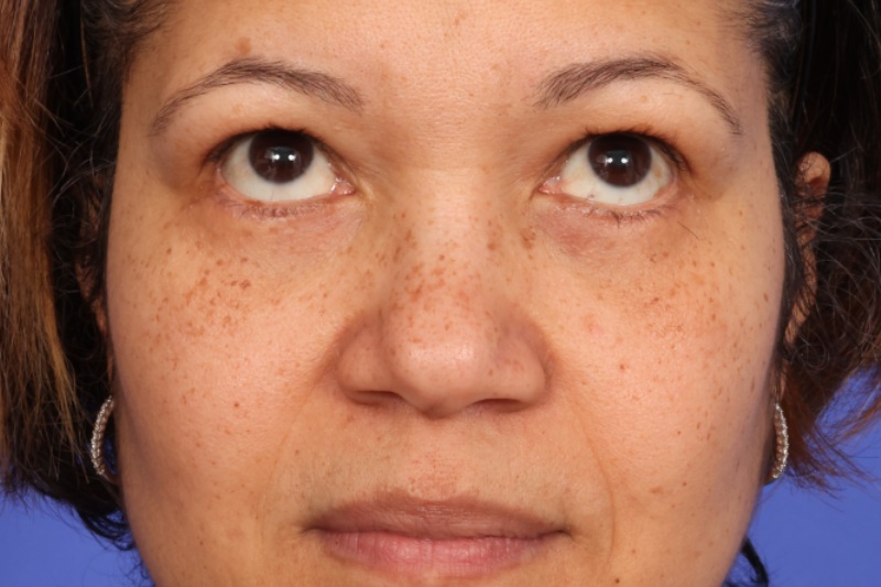 Eyelid Surgery Before & After Image