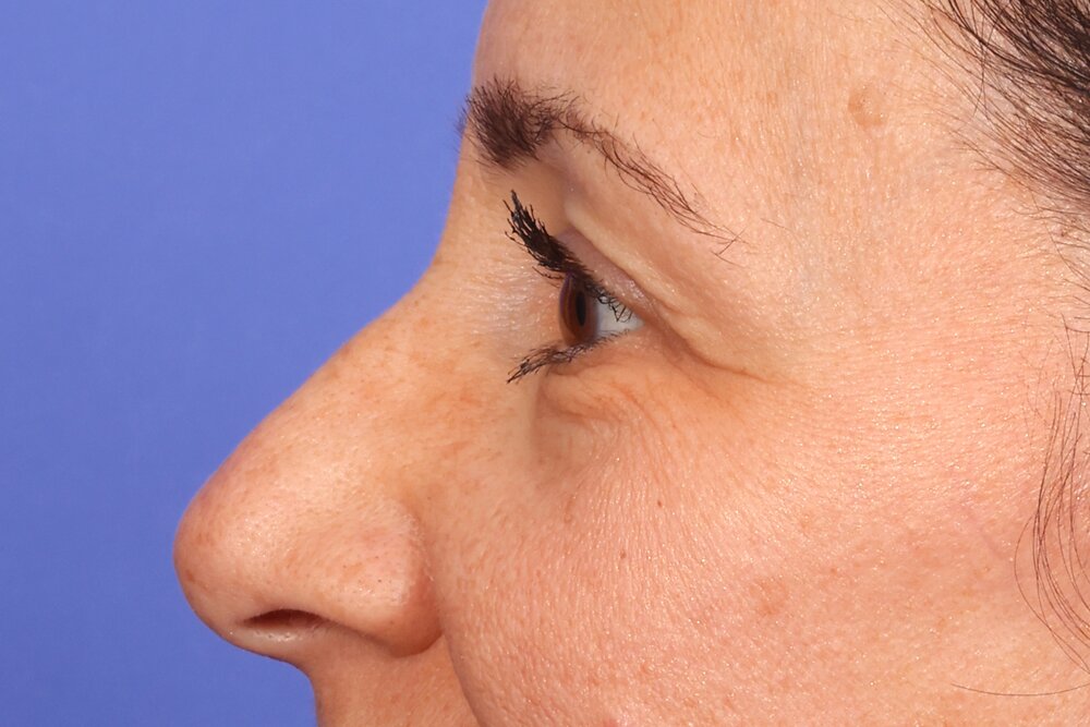 Eyelid surgery Before & After Image