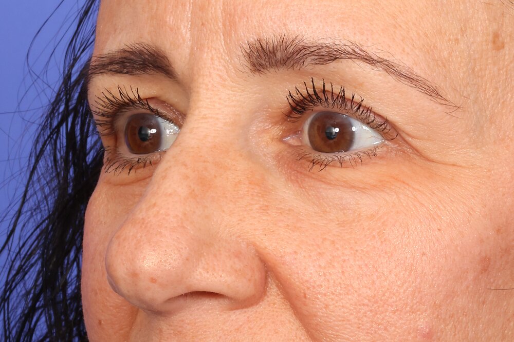 Eyelid Surgery Before & After Image