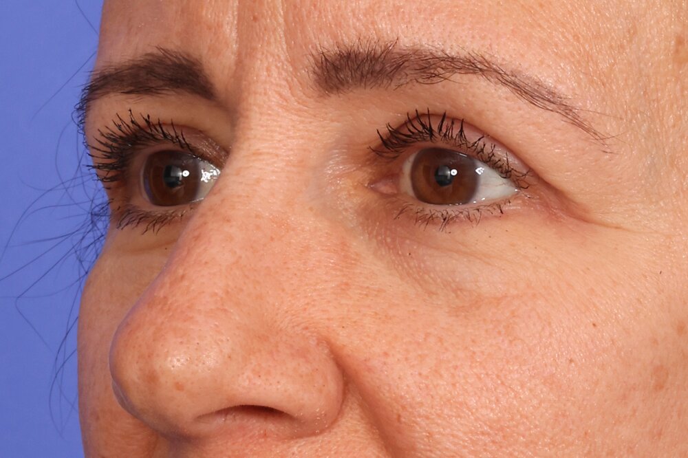 Eyelid Surgery Before & After Image
