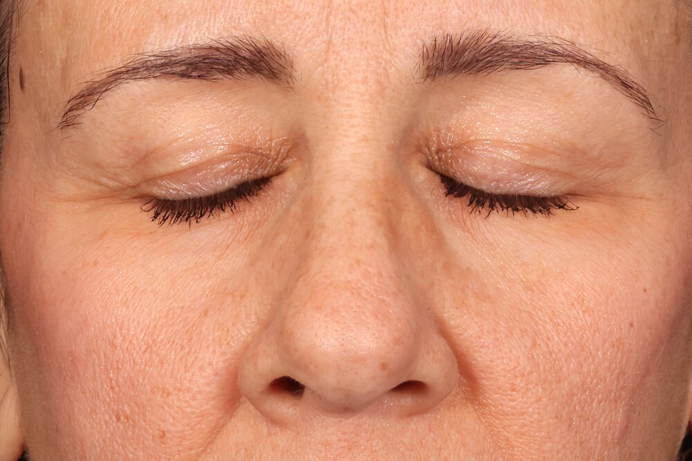 Eyelid Surgery Before & After Image