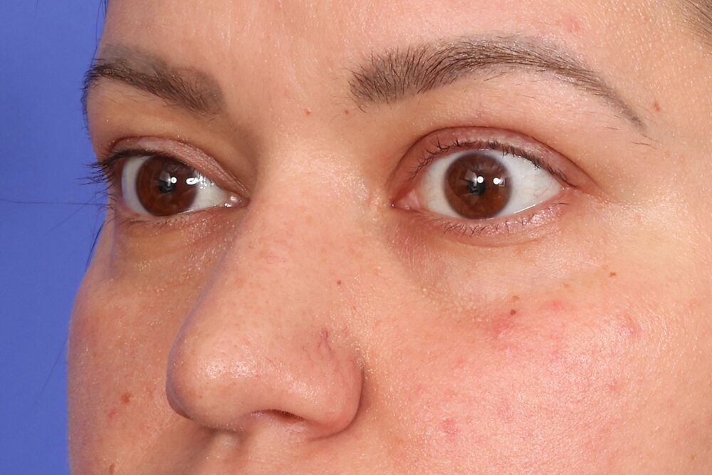 Eyelid Surgery Before & After Image