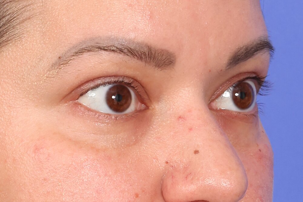 Eyelid Surgery Before & After Image