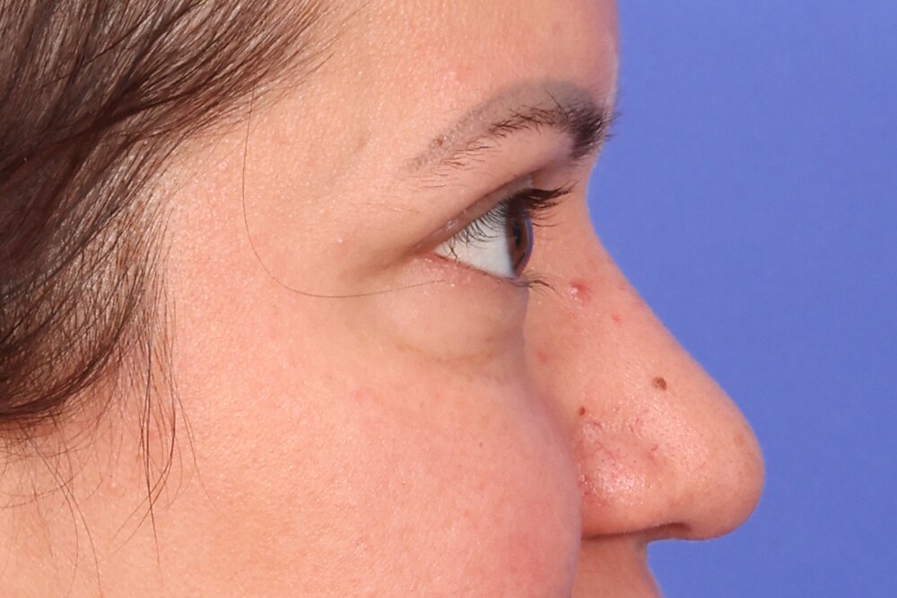 Eyelid Surgery Before & After Image