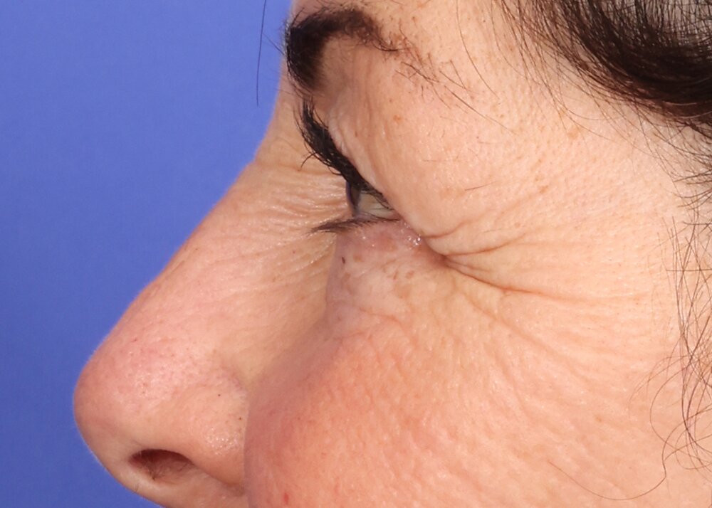 Eyelid surgery Before & After Image