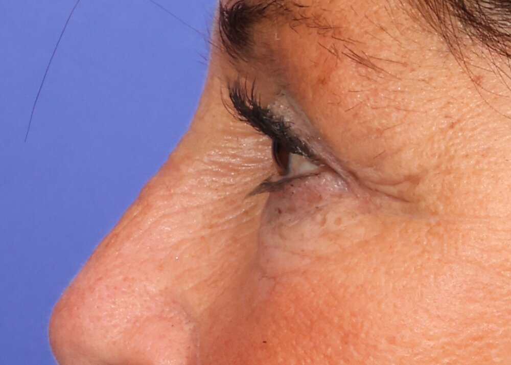 Eyelid surgery Before & After Image