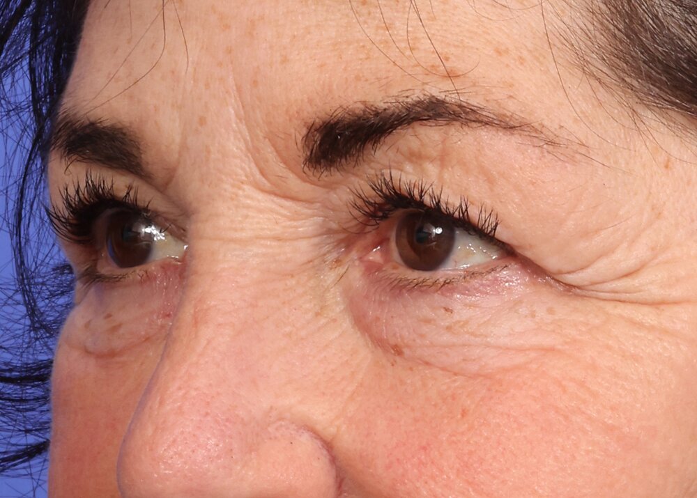 Eyelid Surgery Before & After Image