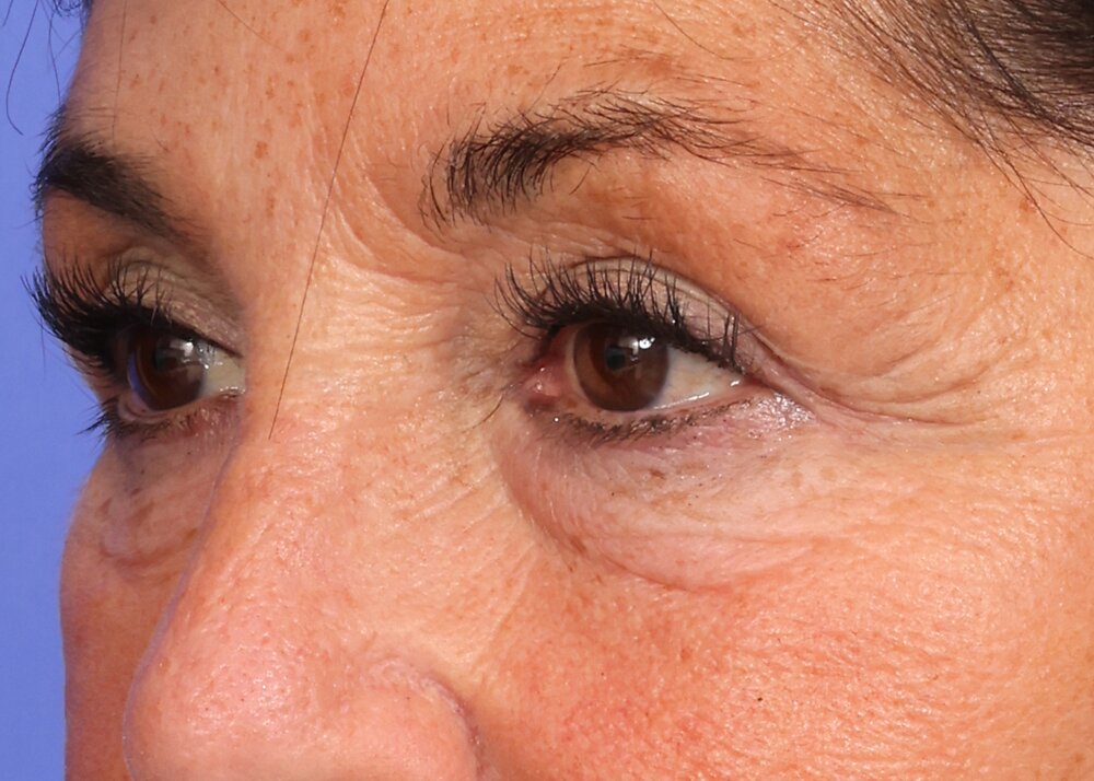 Eyelid Surgery Before & After Image
