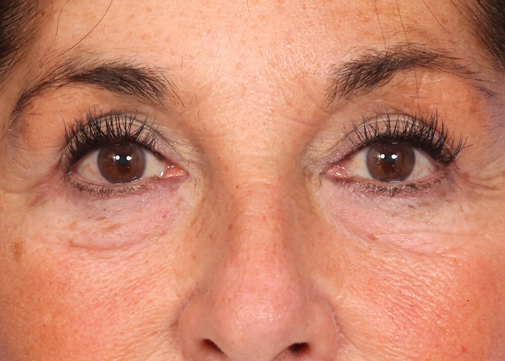 Eyelid Surgery Before & After Image