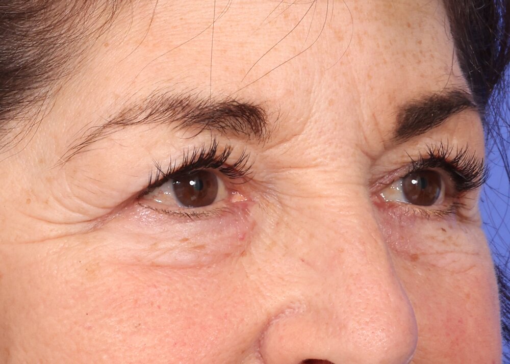 Eyelid Surgery Before & After Image