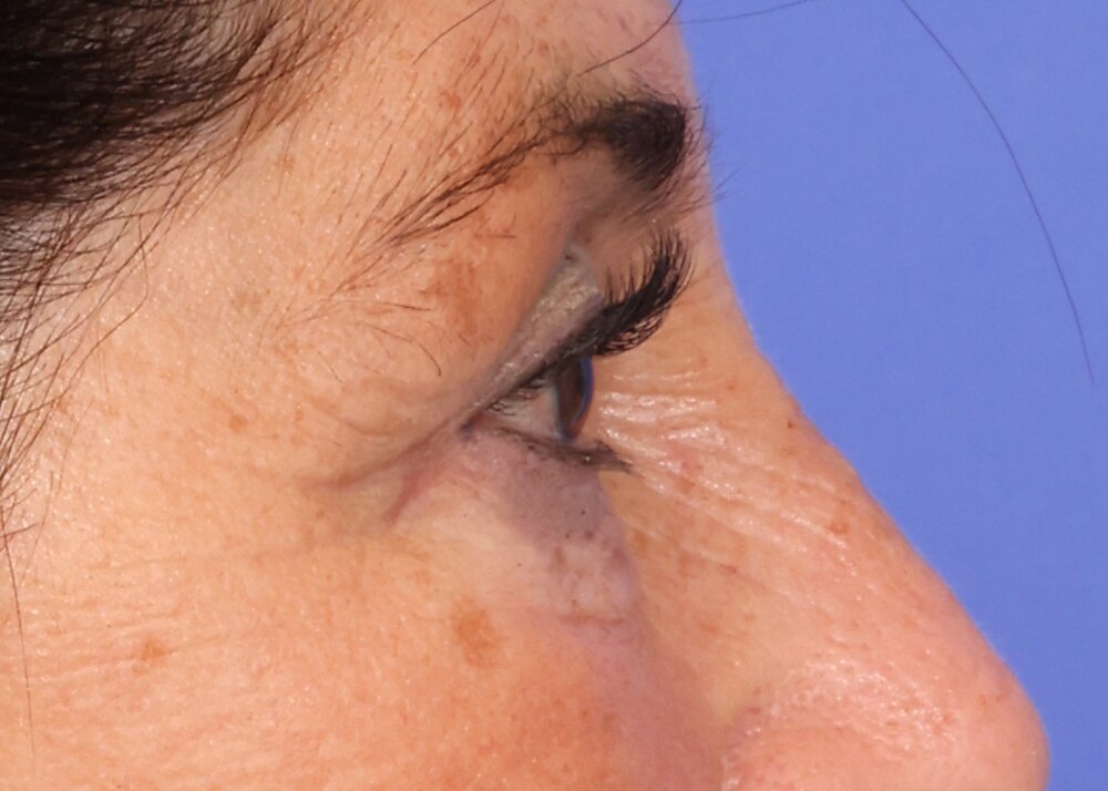 Eyelid Surgery Before & After Image