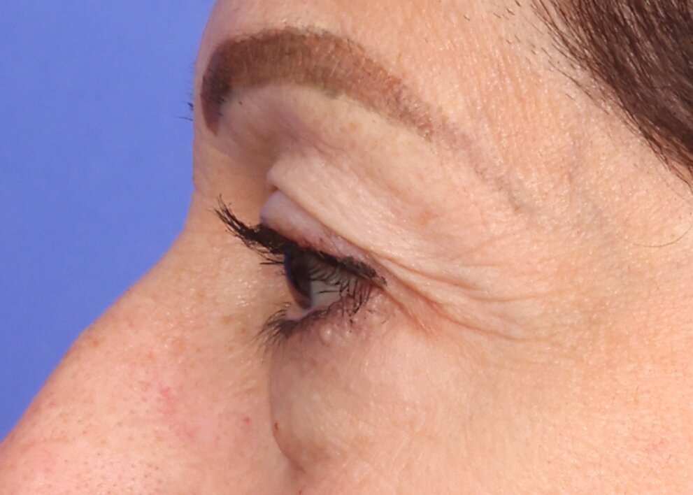 Eyelid Surgery Before & After Image
