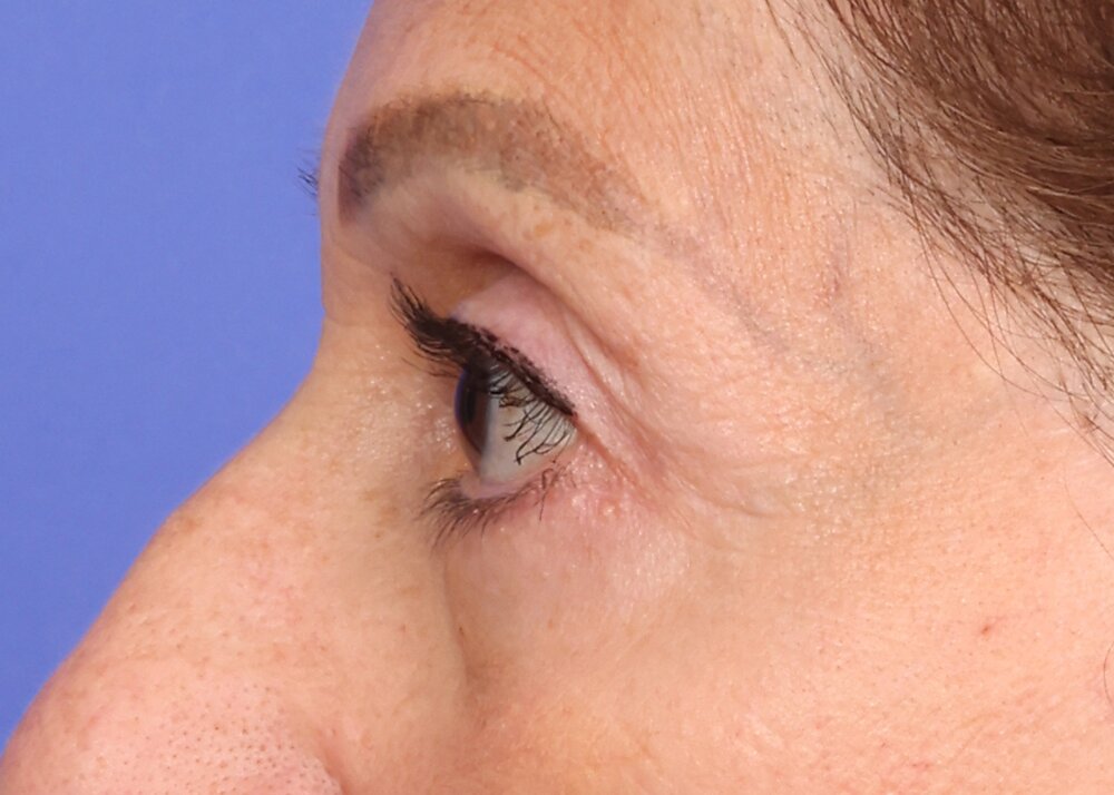 Eyelid Surgery Before & After Image
