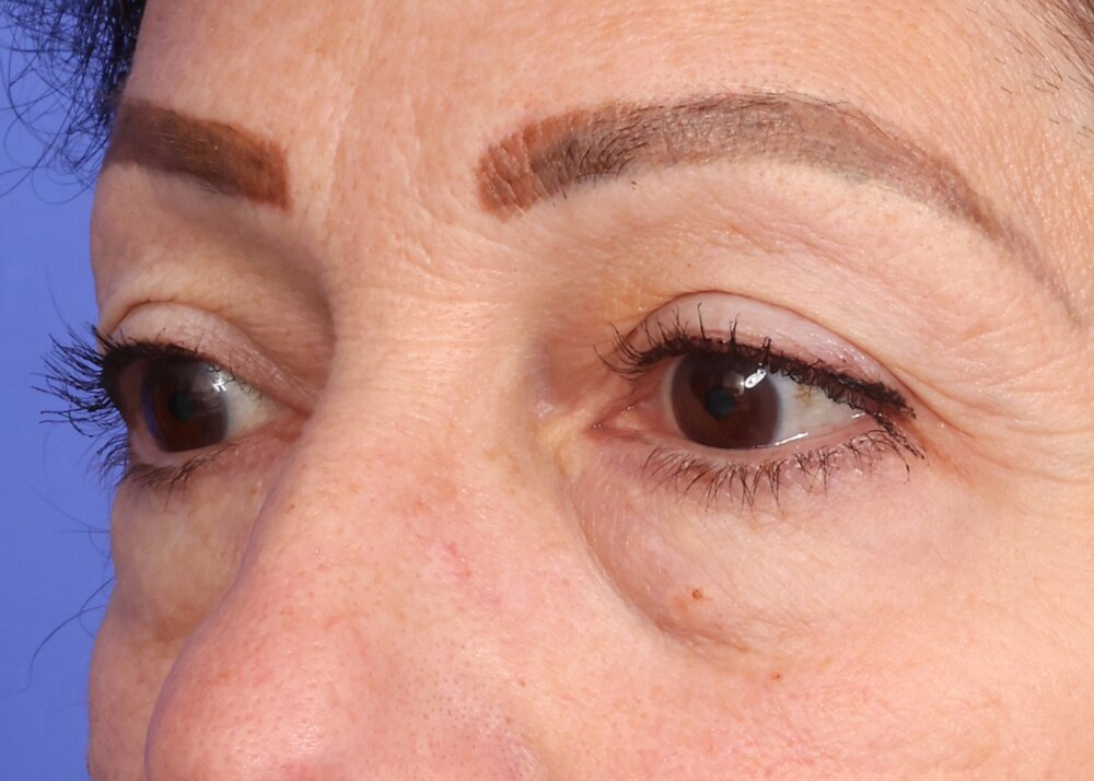 Eyelid Surgery Before & After Image