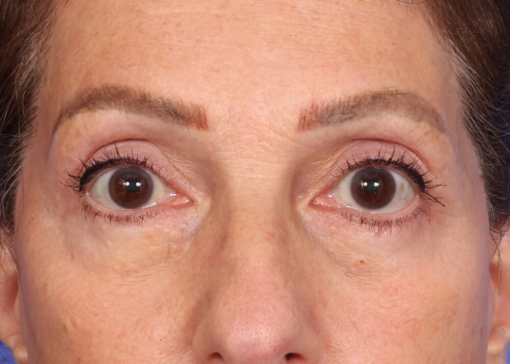 Eyelid Surgery Before & After Image