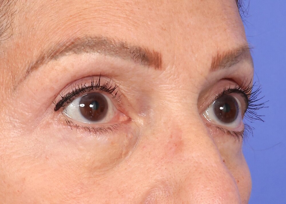 Eyelid Surgery Before & After Image
