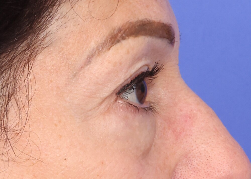 Eyelid Surgery Before & After Image