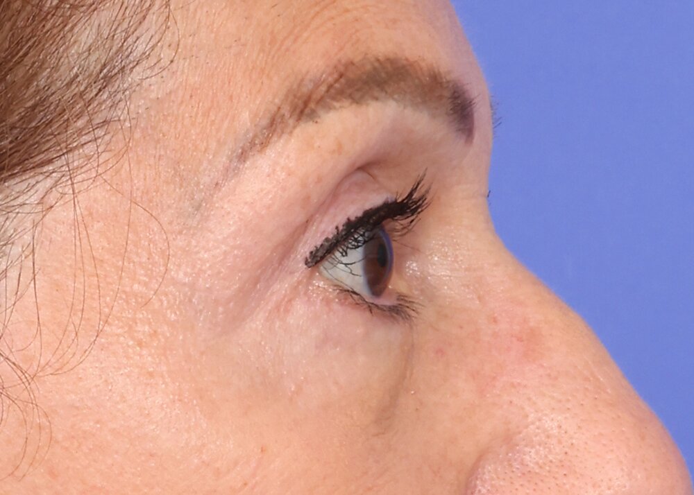 Eyelid Surgery Before & After Image