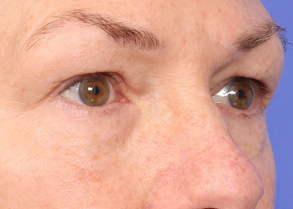 Eyelid Surgery Before & After Image