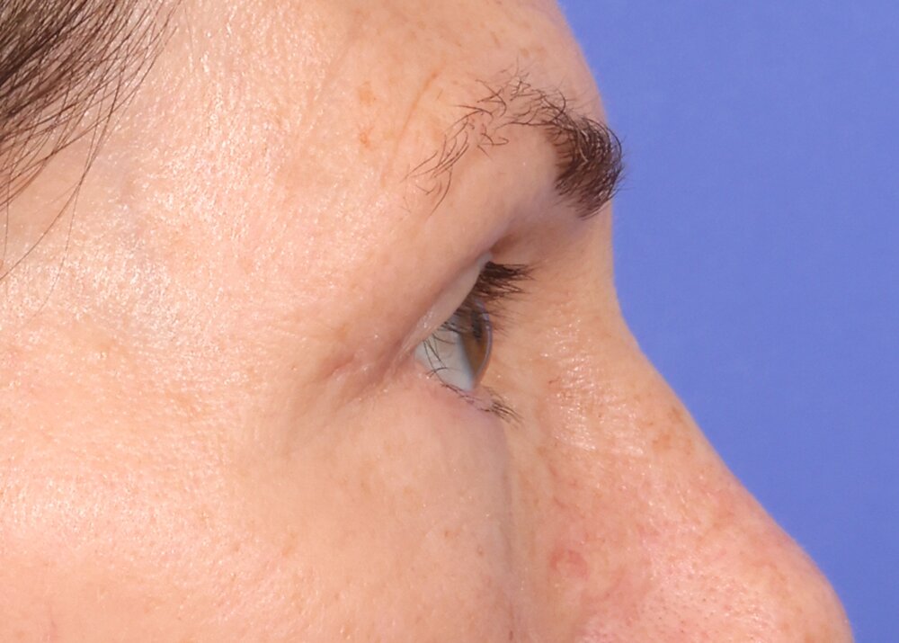 Eyelid Surgery Before & After Image