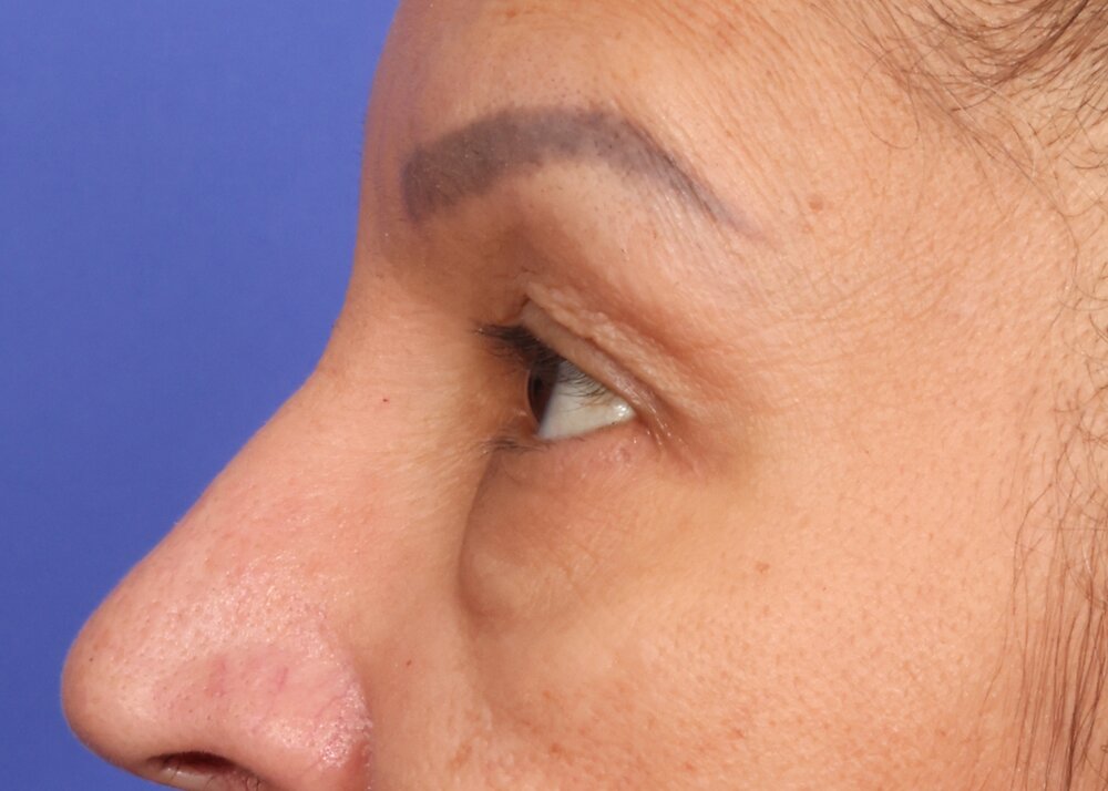 Eyelid Surgery Before & After Image