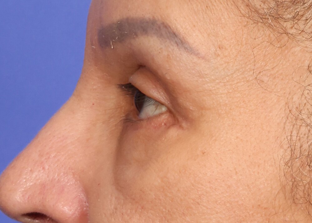 Eyelid Surgery Before & After Image