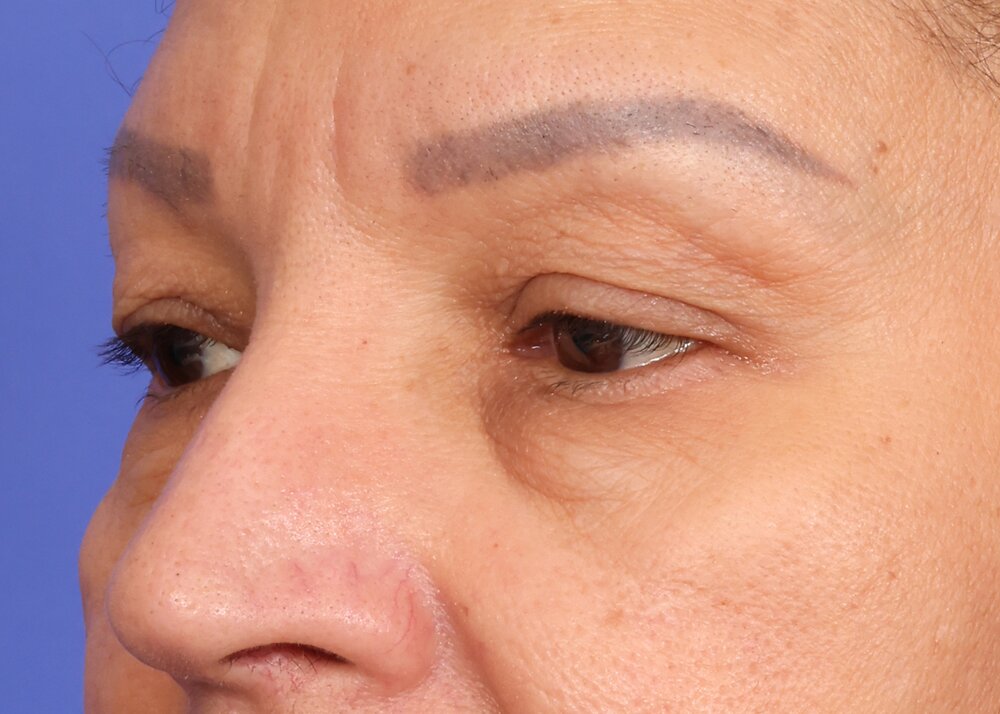 Eyelid Surgery Before & After Image