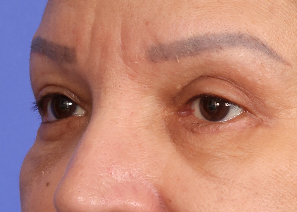 Eyelid Surgery Before & After Image