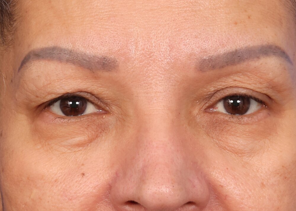 Eyelid Surgery Before & After Image
