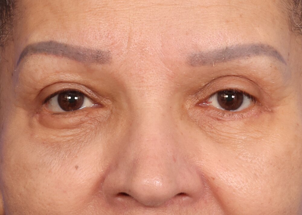 Eyelid Surgery Before & After Image