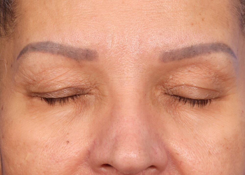 Eyelid Surgery Before & After Image