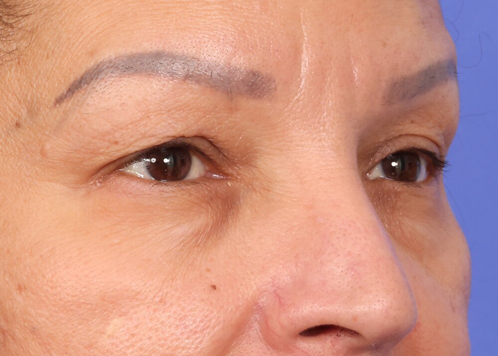 Eyelid Surgery Before & After Image