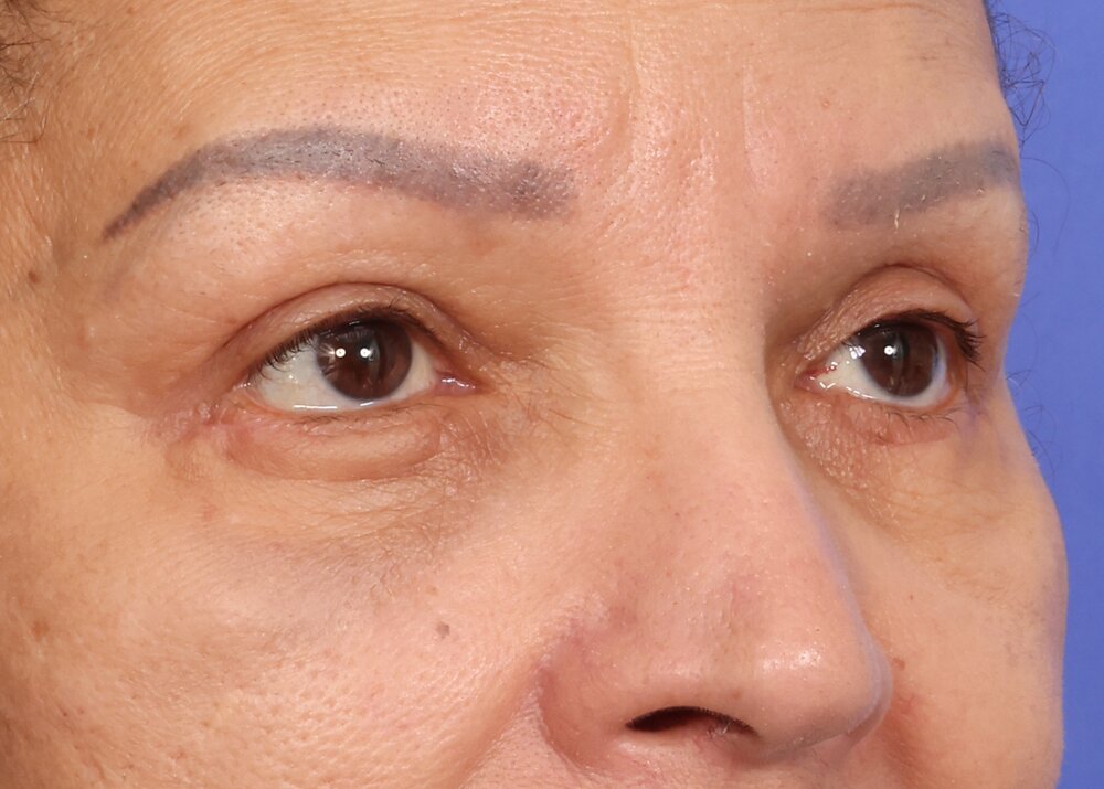 Eyelid Surgery Before & After Image