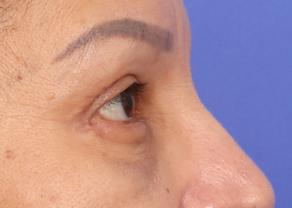 Eyelid Surgery Before & After Image
