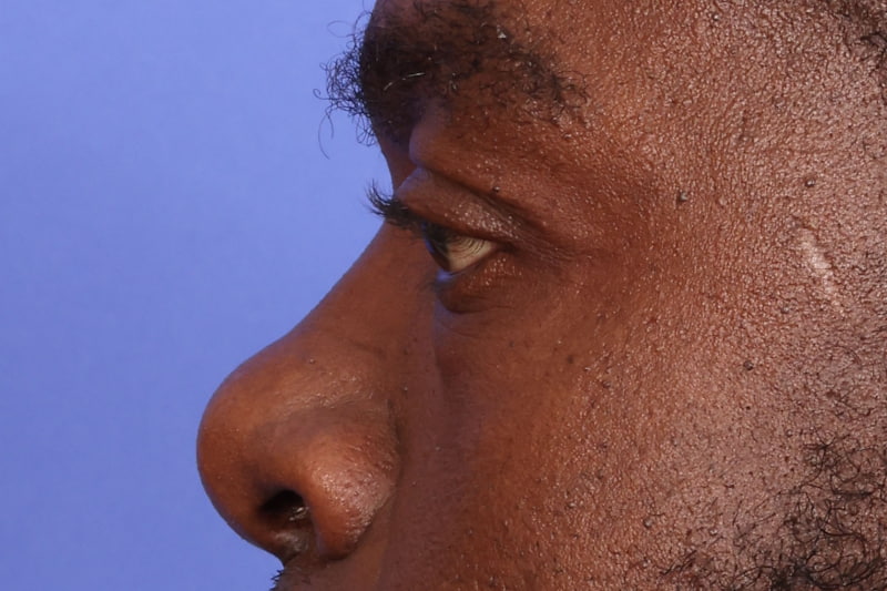 Eyelid Surgery Before & After Image