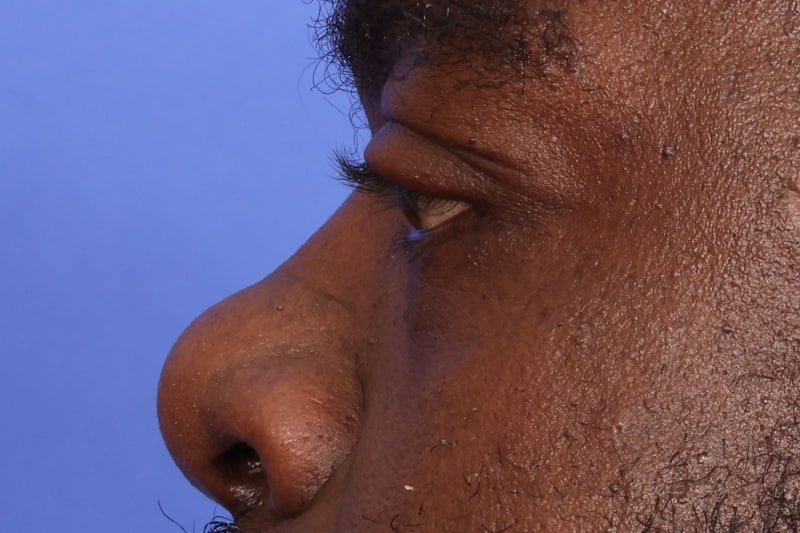 Eyelid Surgery Before & After Image